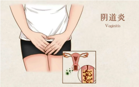 女性有这些症状可能是阴道炎！